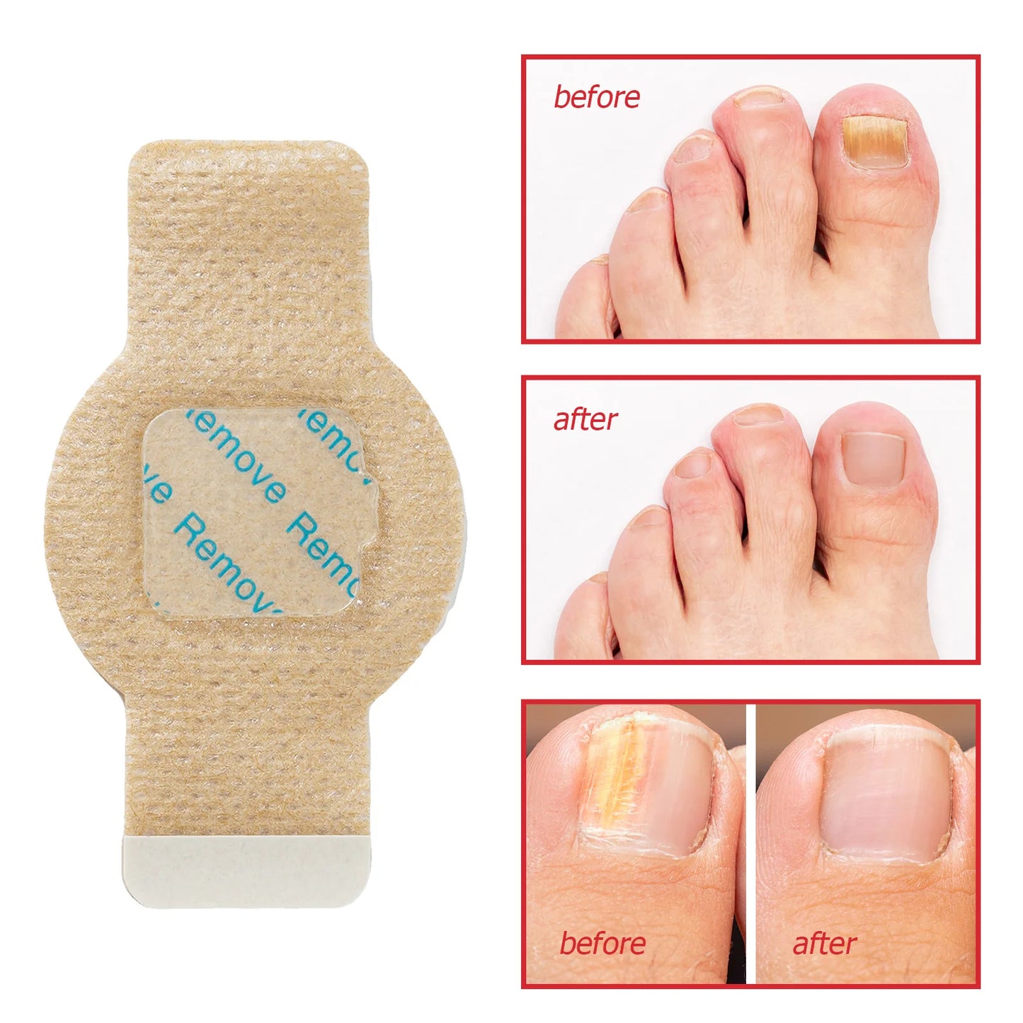 PureNail™ - Nagelpflaster für Schönere Fussnägel