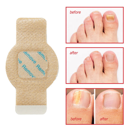 PureNail™ - Nagelpflaster für Schönere Fussnägel