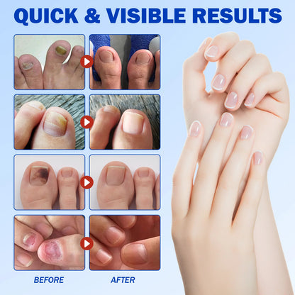 PureNail™ - Nagelpflaster für Schönere Fussnägel
